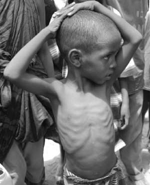 Malnutrition In Children